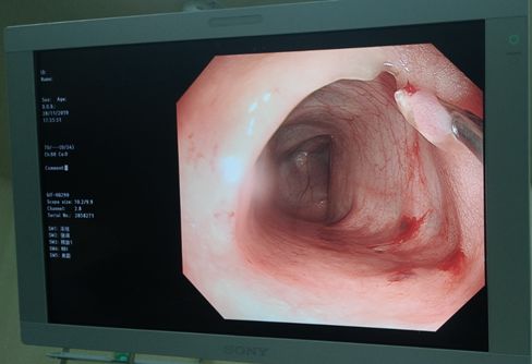 肠息肉 肠镜图片
