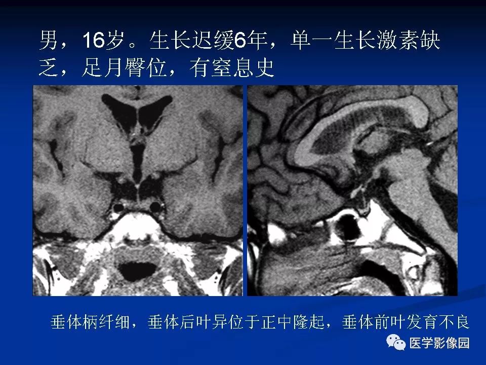 垂体柄阻断图片