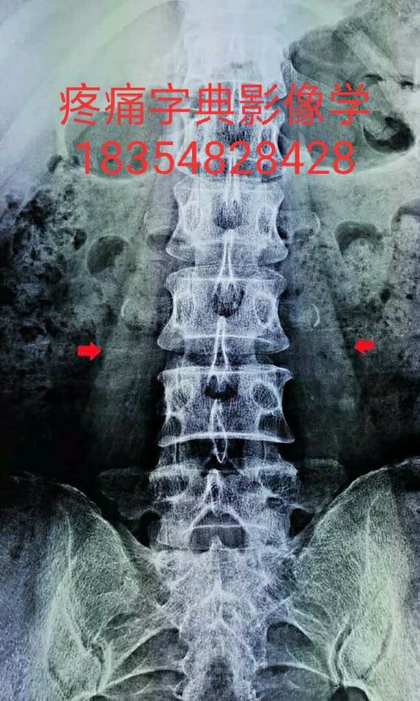 ct上,横断面要注意观察两侧腰大肌是否相对等大,如果过度不等,则考虑