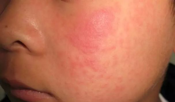 风疹:淡红色斑疹或丘疹