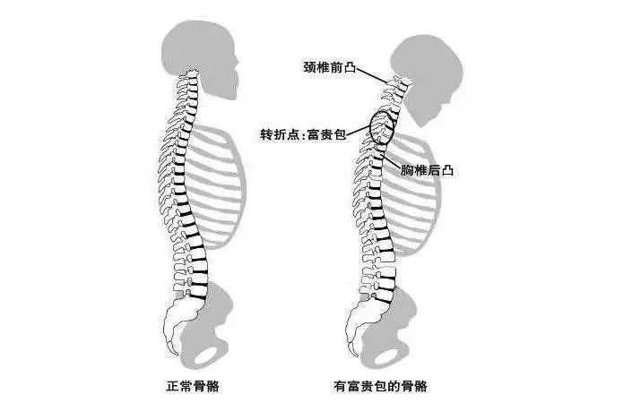 大包,指的是在后背上部颈胸交界处,第七颈椎和第一胸椎有凸起的硬包块