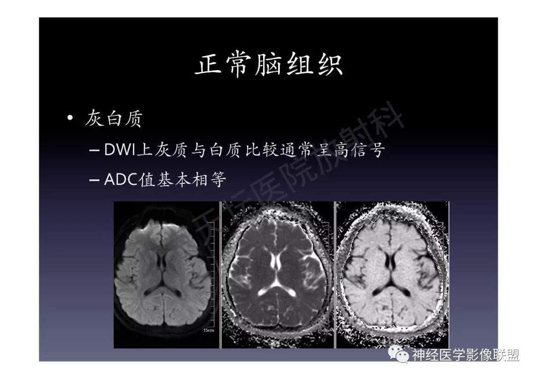 颅内dwi高信号的mri诊断思路