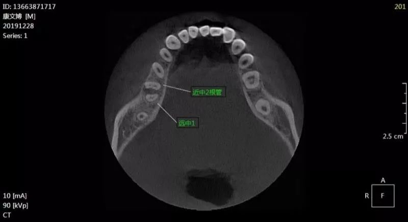 康xx2019122846根尖周炎ct136xxxx1717