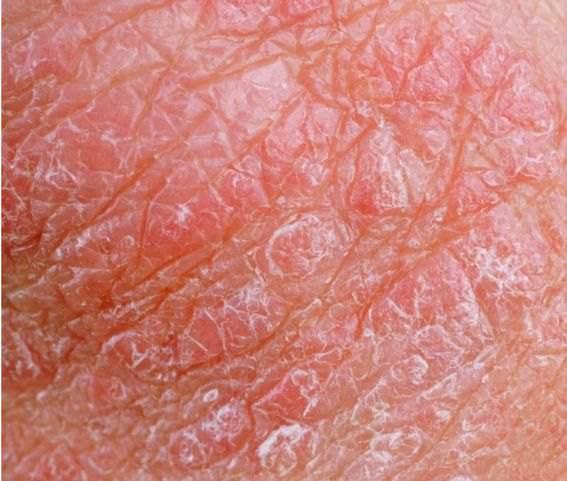 这很可能不是皮肤干燥这么简单,很有可能是得了乏脂性湿疹!