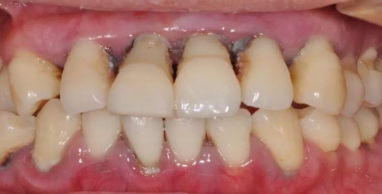 这些小萌懊悔不已,痛恨自己没能早点重视牙齿的问题,她说: "  原来,我