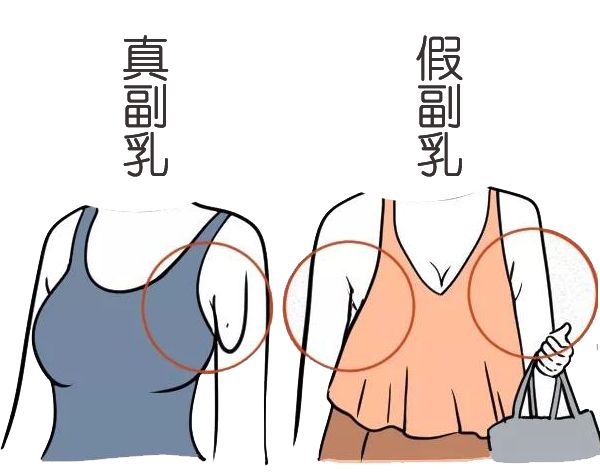 帶有乳頭副乳是指人體除正常乳房外出現的多餘乳房並不一定是