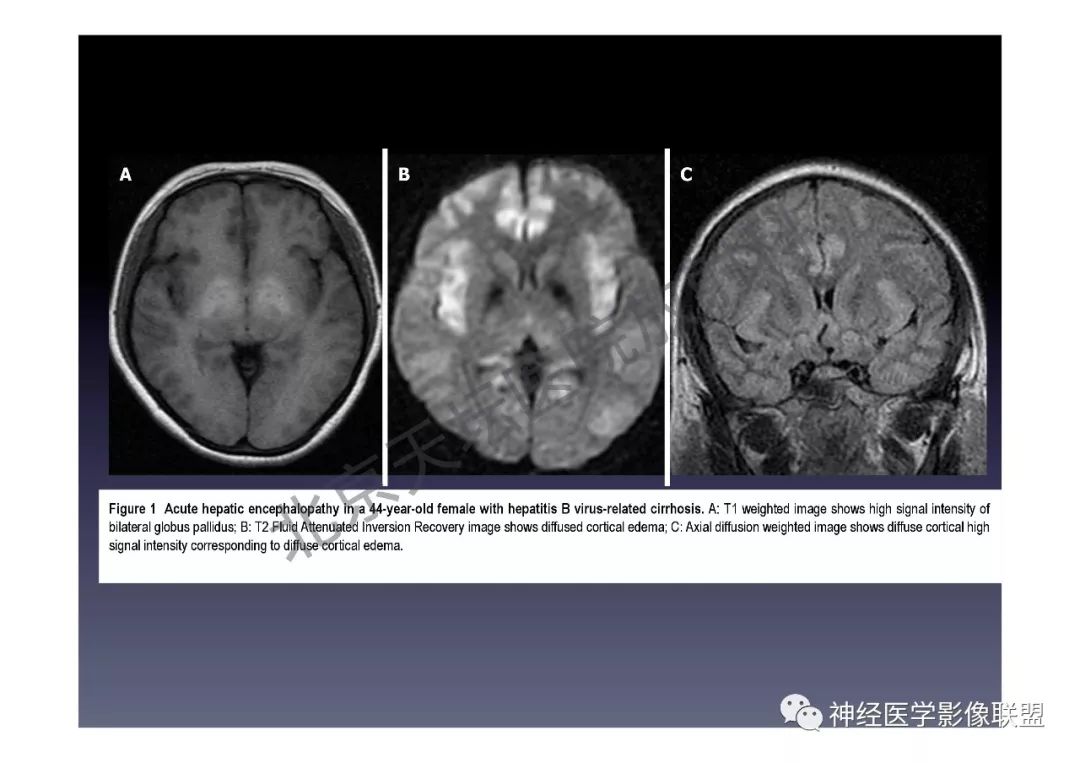 颅内dwi高信号的mri诊断思路