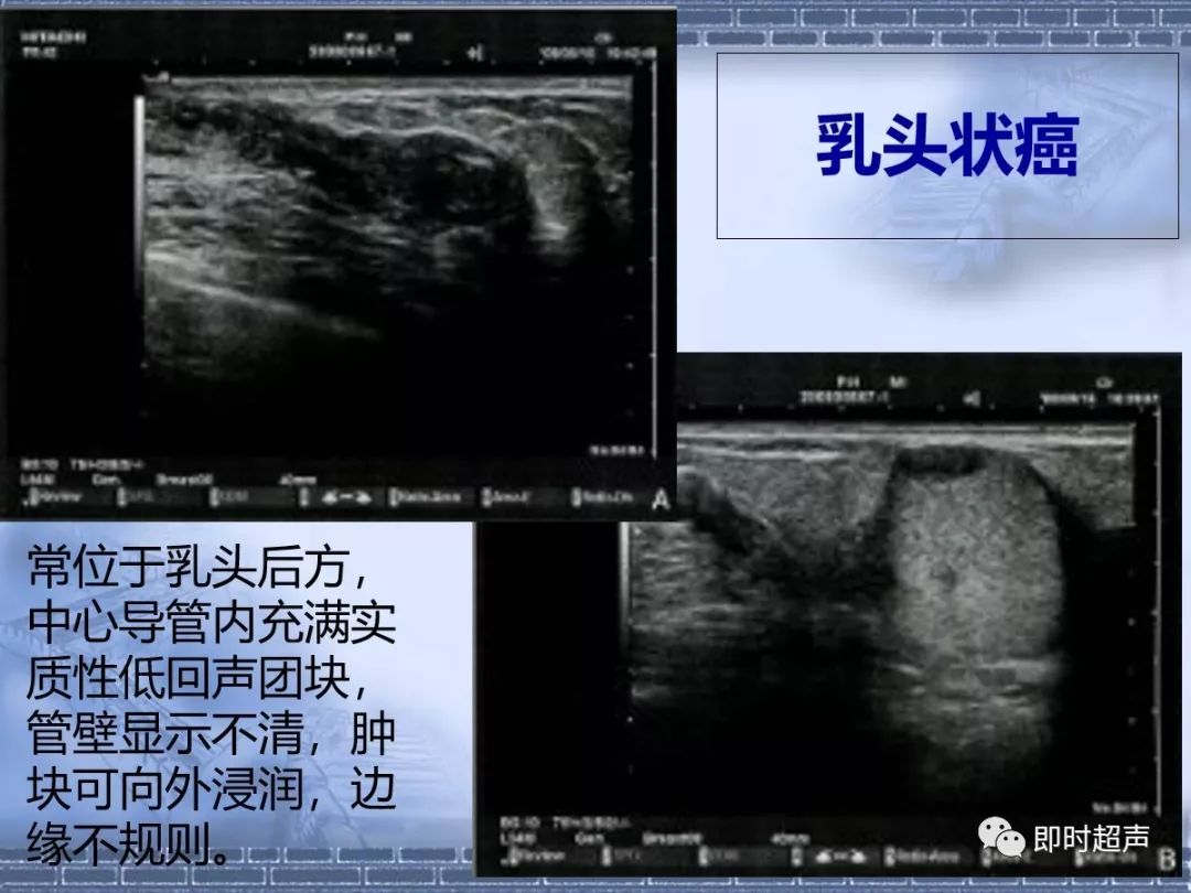 乳腺癌的超声诊断