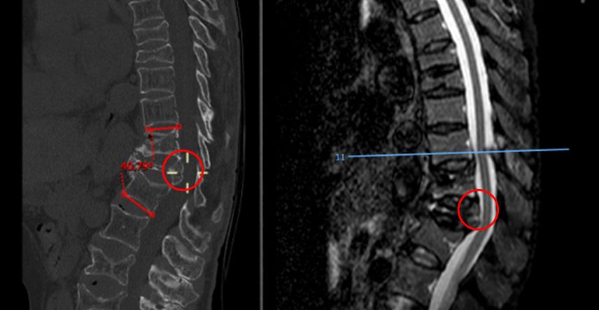 t12椎体压缩明显,椎体后缘 向后突出占位,压迫脊髓