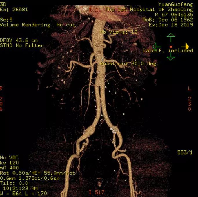 腹主动脉分支解剖图ct图片