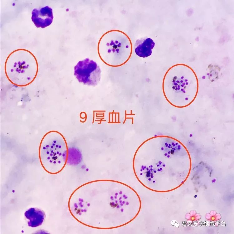 ▼「疟原虫裂殖体(厚血片)」形态特征:裂殖子较大,红核蓝浆,数目较多