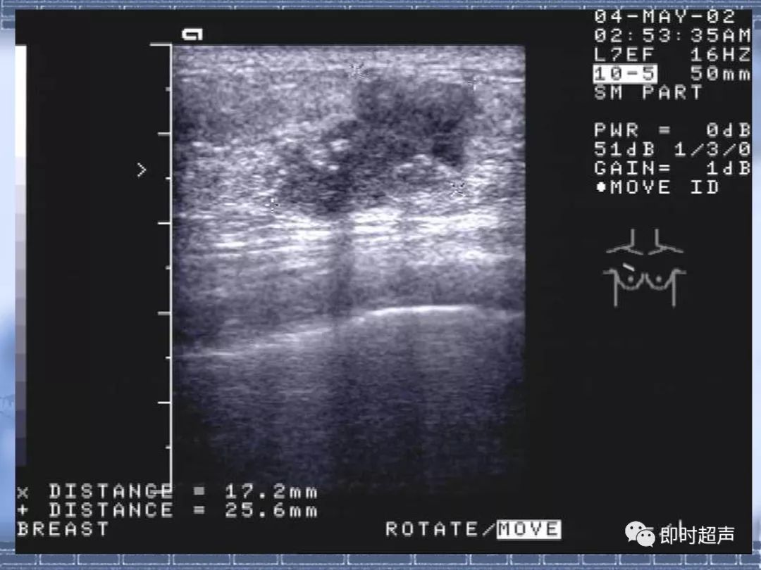 乳腺癌的超聲診斷