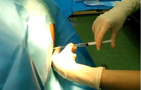 原创剖腹产怎么打麻醉的?疼吗?有啥后遗症?专家揭秘,果断收藏