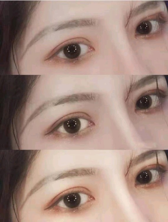 太原华美说全切双眼皮和定点双眼皮选哪个更好