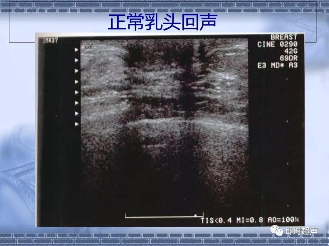 乳腺癌的超聲診斷