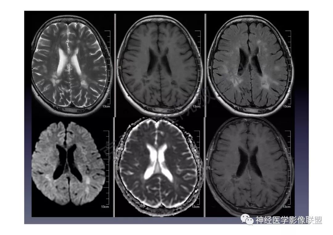 颅内dwi高信号的mri诊断思路