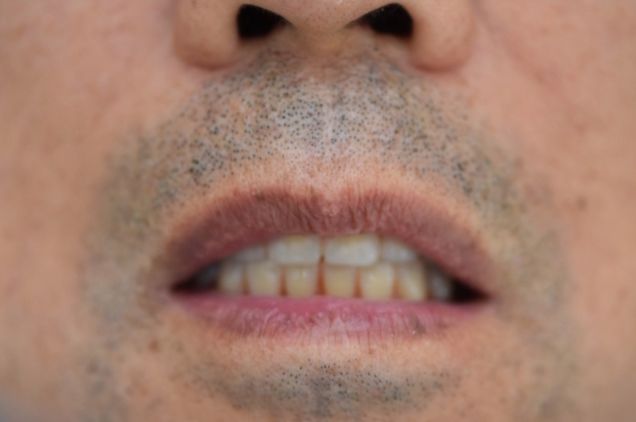 重磅!北京市六旬老人全口松牙烂牙一颗没拔全固定