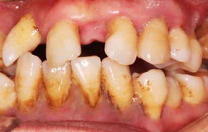 北京市六旬老人全口松牙烂牙一颗没拔全固定_牙齿