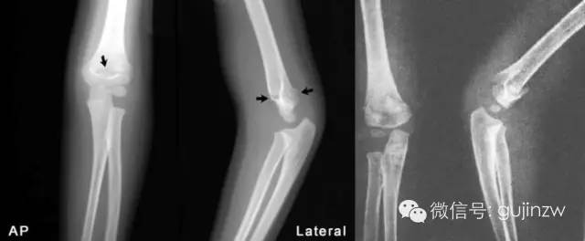 42张x线片带你读懂不同部位骨折_肱骨