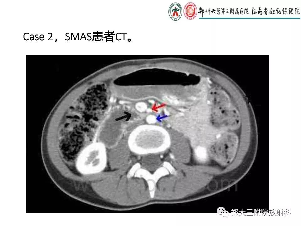 肠系膜上动脉综合征