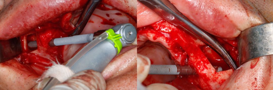 cm.12,22植入nobel active 3.5/10mm,双侧初期稳定性均为50n.cm.