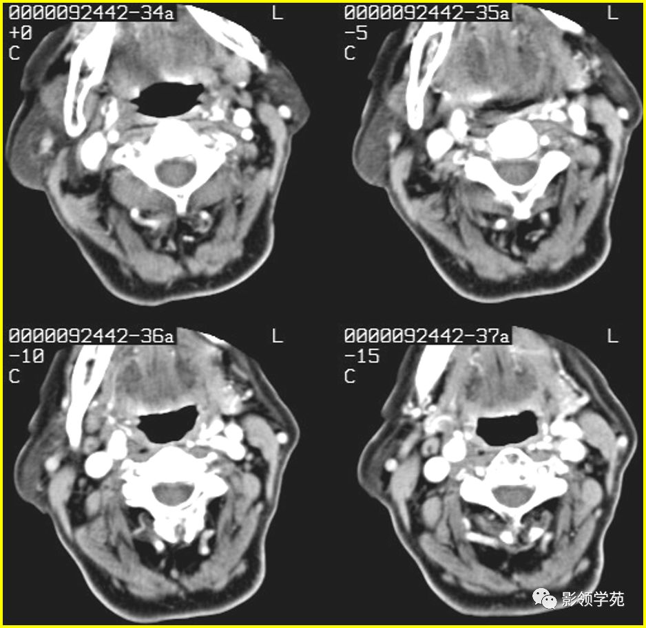 腮腺颈部疾病影像诊断