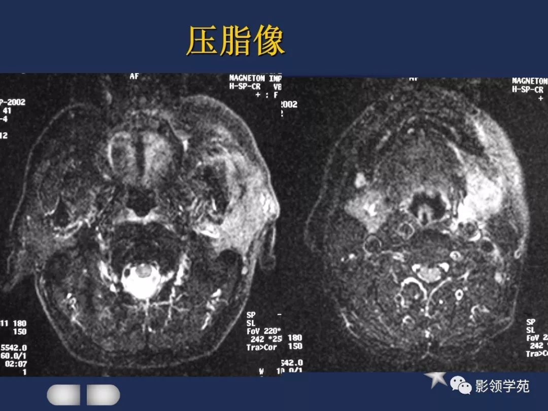 腮腺頸部疾病影像診斷