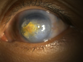 眼角膜也能染色90后小伙那只跟随25年的白眼睛终于正常了