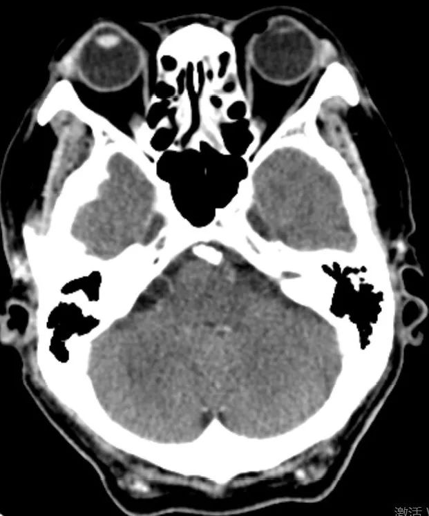 中国神介500人病例集锦第66期韩志安教授专辑