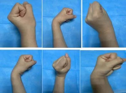 屈肘运动:只适用于关节上置管的患者,促进血液循环,预防关节僵硬疼痛