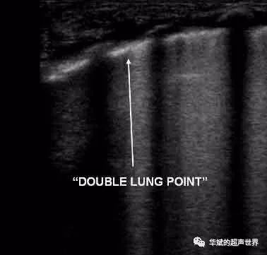 diagnosis of neonatal transient tachypnea and its