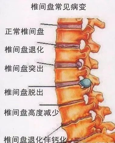 腰间盘突出在哪个位置图片