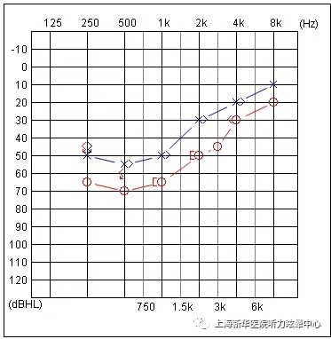 入院后行相关辅助检查追问病史:患者在此次发病之前,双侧听力均正常