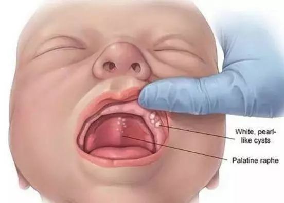 来源:维基百科教训六婴儿身上抹锅底灰导致败血症有的婴儿生下来身上