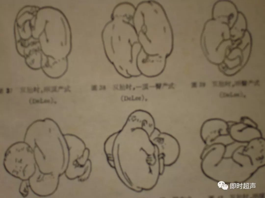 双胎及多胎妊娠综述