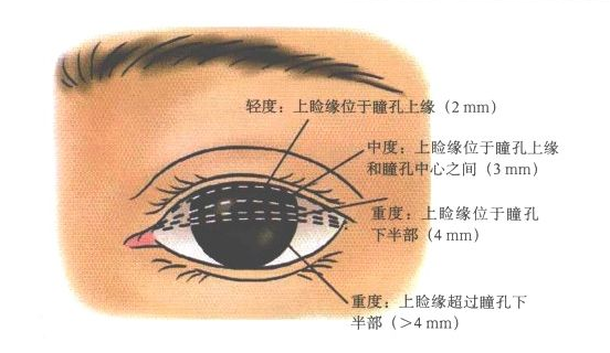 【余文林】了解上睑下垂,抓住最佳矫正时期