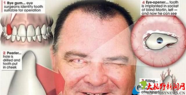 盲人的福音将牙齿移植进眼睛后几个月便可恢复光明