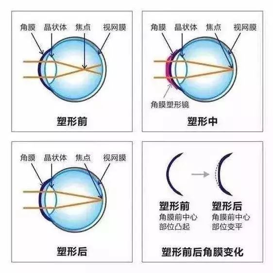 特别适合眼球正在发育期的青少年近视患者.