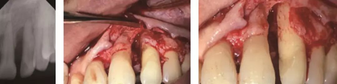 牙槽骨手术失败图片图片
