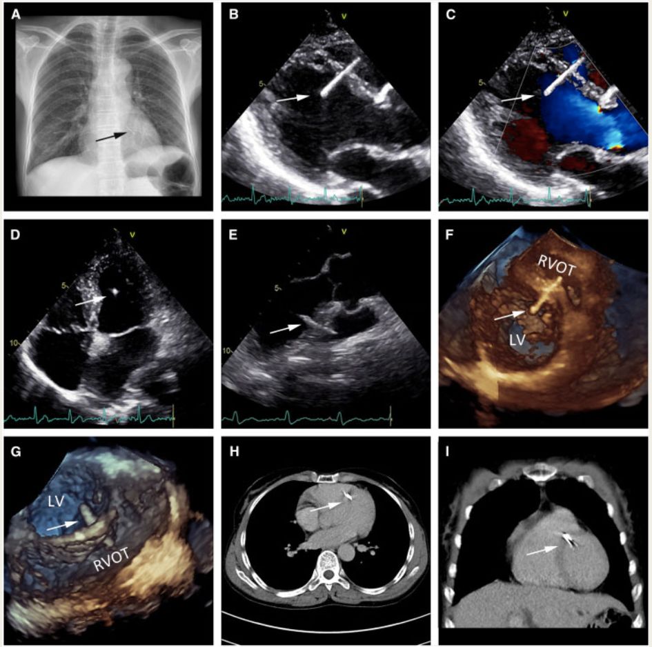 一个不寻常的病例:心脏上的绣花针