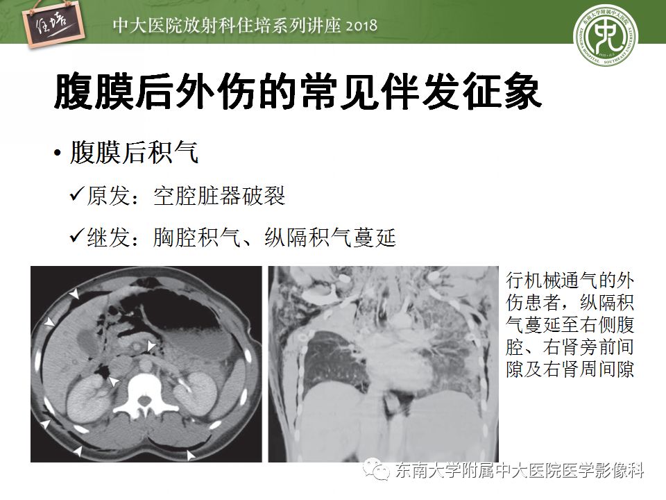 腹膜后外伤的ct表现