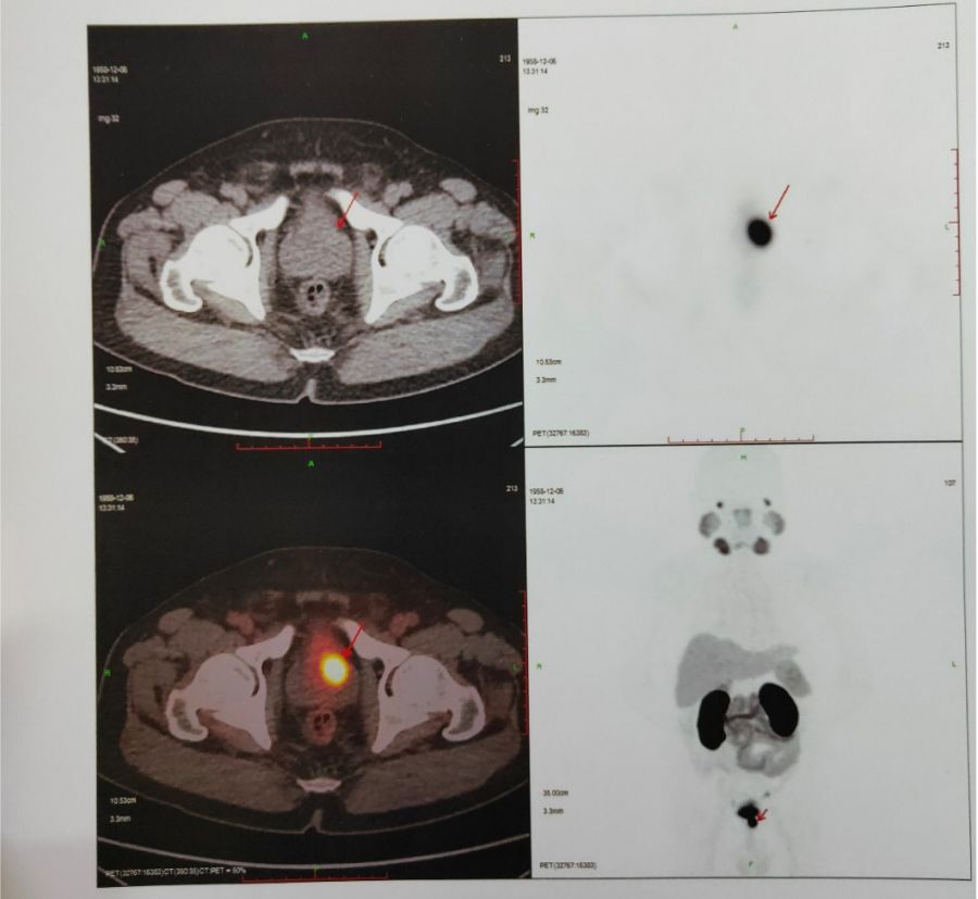 ga标记的psma-petct检查进一步临床诊断,结果显示前列腺左叶高摄取灶