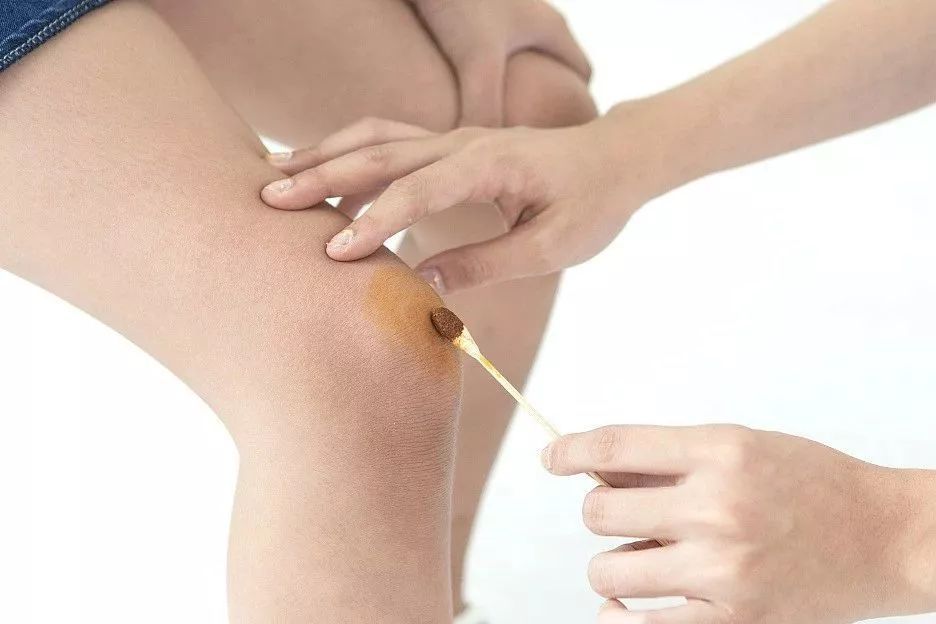 狐大医   牙膏,白酒,盐……这些伤口消毒方法会让你伤更重!