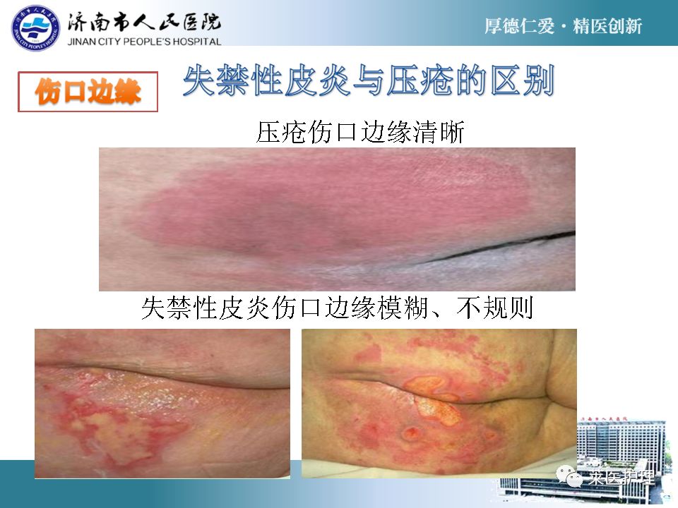 ppt老年失禁性皮炎的护理