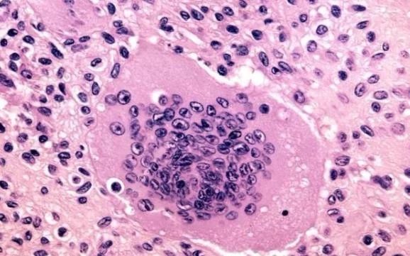 骨癌细胞图片