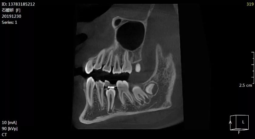 石xx201912303536颌骨囊肿ct137xxxx5212