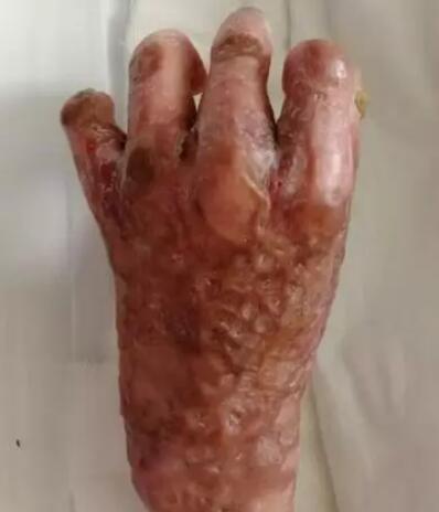 锅炉爆炸,命悬一线——22岁大面积烧伤小伙被成功救治