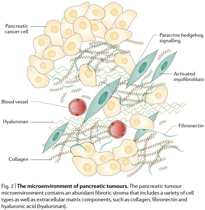 胰腺癌龟壳一般厚的细胞外基质,让免疫细胞难以浸润,就算它们渗透进去