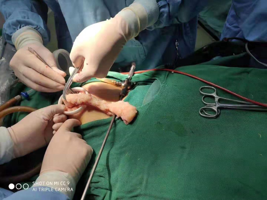 手术剔除14cm13cm巨大子宫肌瘤却找不到瘢痕