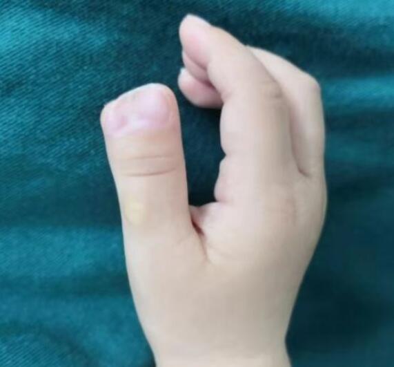 一岁宝宝右手拇指多指畸形,手外科专家完美矫正,让宝宝健康成长